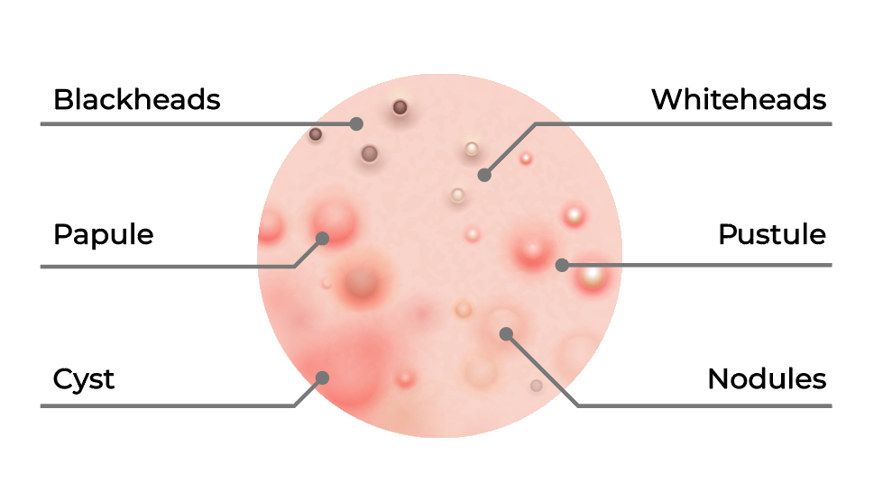 Why your acne is getting worse.